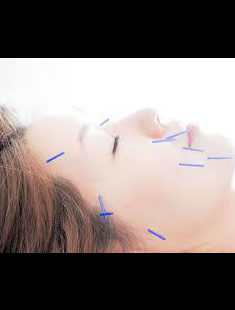 美容鍼灸_顔鍼